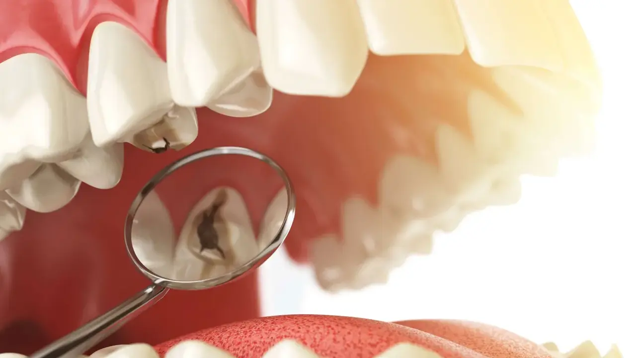 Widok jamy ustnej z lusterkiem dentystycznym pokazującym ubytek, który wymaga wypełnienia. Plomba chemoutwardzalna to rozwiązanie dla tego problemu.
