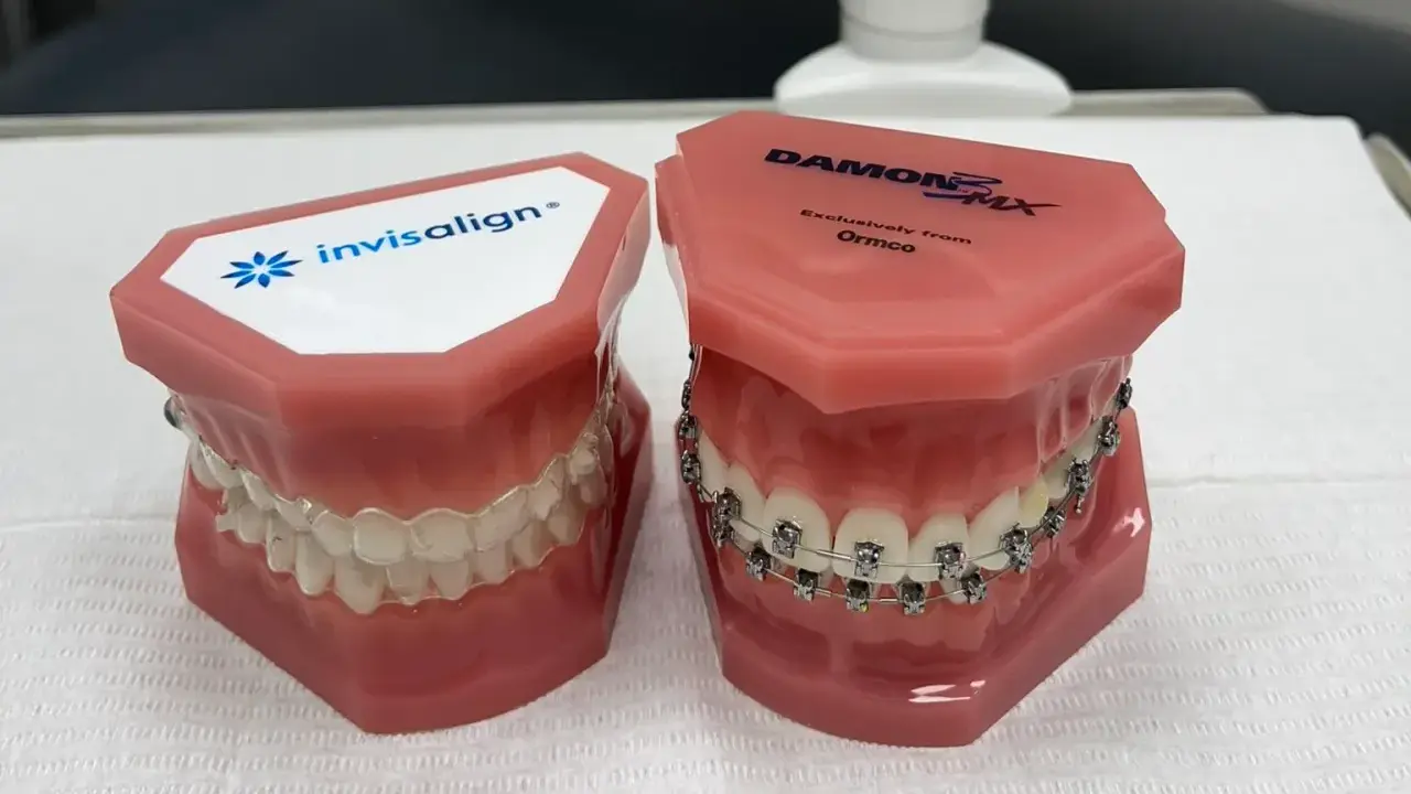 Modele szczęk pokazują tradycyjny aparat ortodontyczny i przezroczyste nakładki Invisalign. Dowiedz się, co to Invisalign i jak działa.