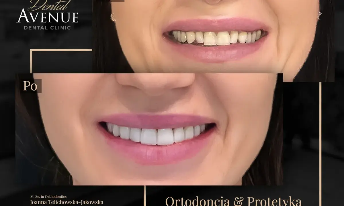 Przed i po: metamorfoza uśmiechu dzięki bondingowi zębów. Piękne, białe zęby po zabiegu.