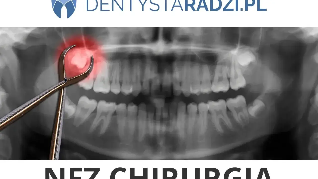 Rentgen zęba z kleszczami i czerwoną plamą. Dowiedz się, ile kosztuje wyrwanie zęba w NFZ chirurgia.