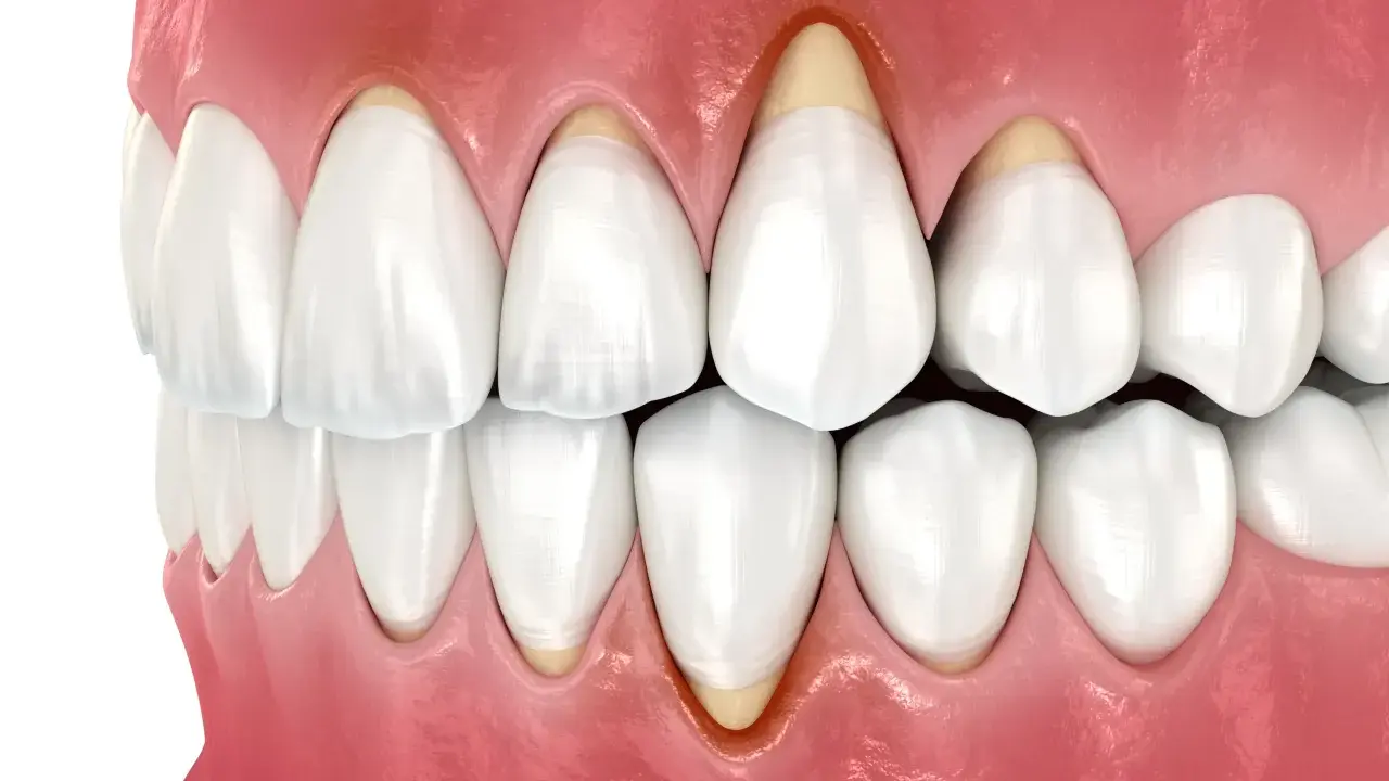 Zbliżenie na zęby i dziąsła, ukazujące odsłonięte korzenie zębów, co może być przyczyną tzw. gummy smile.