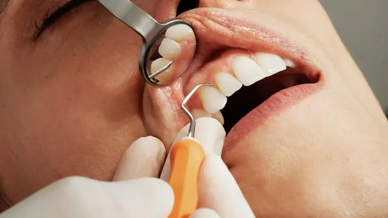 Dentysta wykonuje skaling zębów, używając narzędzi i lusterka.