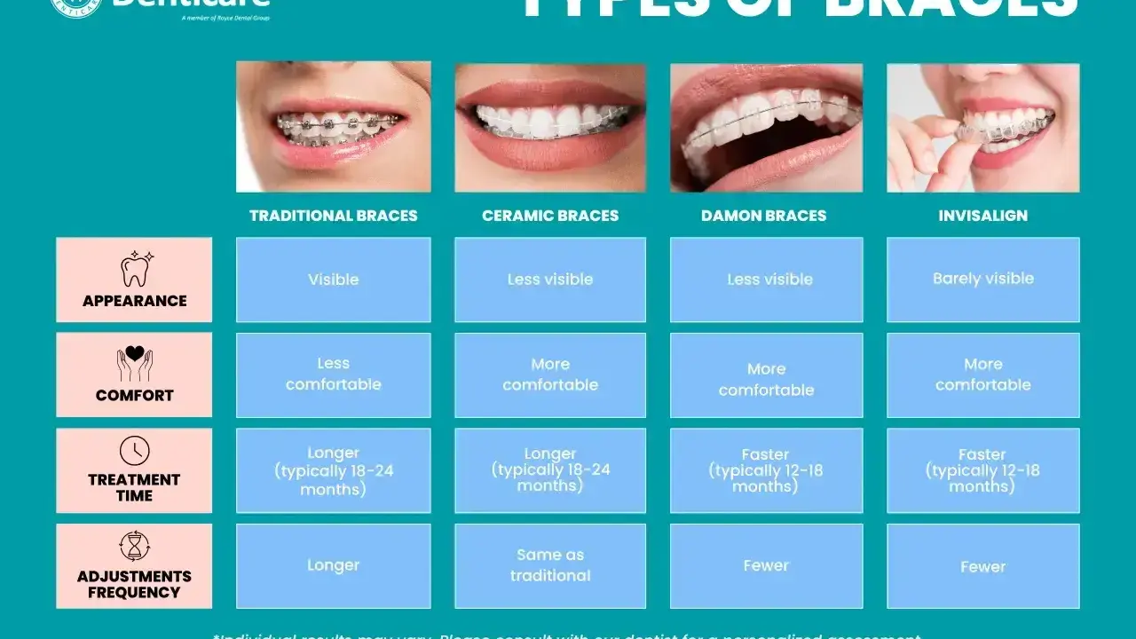 Porównanie aparatów ortodontycznych: tradycyjne, ceramiczne, Damon i Invisalign. Zęby wysunięte do przodu mogą być korygowane.