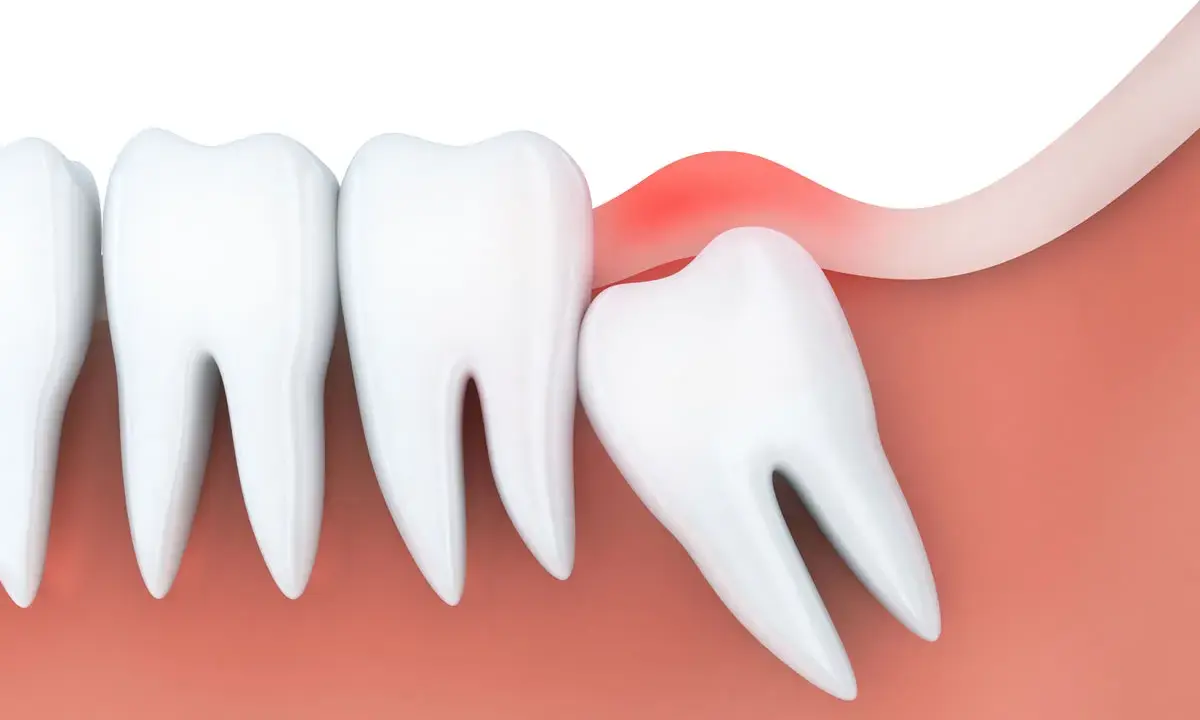 Zapalenie dziąseł wokół ósemki. Czy ósemki się leczy? Czasem wymagają interwencji dentysty.