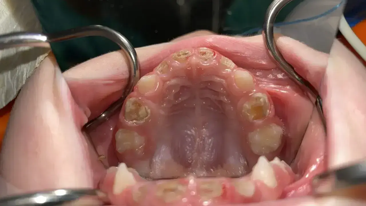 Zaawansowana próchnica zniszczyła zęby, pozostawiając ubytki i przebarwienia. Widoczne są narzędzia dentystyczne.