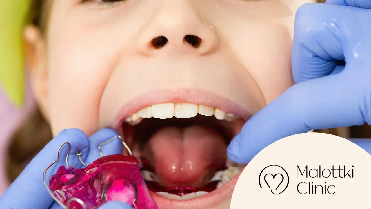 Uśmiechnięte dziecko z różową płytką Hawleya w ustach, przygotowywaną przez dentystę w rękawiczkach.