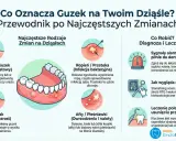 Ilustracja przedstawia ropień, czyli przetokę na dziąśle, jako bolesne zgrubienie z ropą, często spowodowane infekcją zęba.