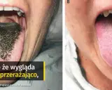 Grzybica jamy ustnej: objawy na zdjęciach i skuteczne leczenie