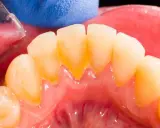 Widok zębów z widocznym, żółtawym kamieniem przy dziąsłach. Widać narzędzie dentystyczne i niebieską rękawiczkę.