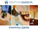 Stripping zębów: przed zabiegiem z użyciem narzędzi i po, widoczna poprawa przestrzeni międzyzębowych (IPR).