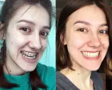 Uśmiechnięta dziewczyna z aparatem ortodontycznym po lewej, po prawej bez, z widoczną poprawą zgryzu, być może po leczeniu progenii.