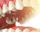 Widok jamy ustnej z lusterkiem dentystycznym pokazującym ubytek, który wymaga wypełnienia. Plomba chemoutwardzalna to rozwiązanie dla tego problemu.