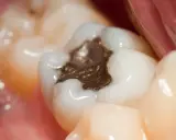 Zbliżenie na ząb z ciemną, metaliczną plombą. Widać też zdrowe, białe zęby i różowe dziąsło.