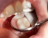 Widok z lusterka dentystycznego na ząb z pękniętą, nieszczelną plombą, która wymaga uwagi.