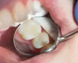 Widok jamy ustnej z lusterkiem dentystycznym, ujawniającym zęby. Uważne oko może dostrzec oznaki **próchnicy ukrytej** między zębami, wymagającej interwencji.
