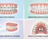 Różne aparaty ortodontyczne: metalowy, estetyczny, nakładki Invisalign i aparat Hyrax do leczenia zgryzu krzyżowego.