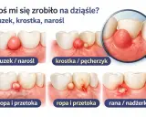 Ilustracja pokazuje różne zmiany na dziąśle: guzek, krostkę, ropień i ranę. Włókniak na dziąśle może przybierać różne formy.
