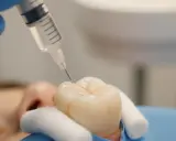 Dentysta aplikuje płyn na ząb. Czy lakowanie zębów jest szkodliwe? Nie, to profilaktyka próchnicy.
