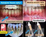 Zanikanie dziąseł i kości (paradontoza) może prowadzić do utraty zębów. Sprawdź, jaka jest recesja dziąseł cena leczenia.