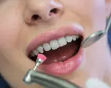 Profesjonalne usuwanie kamienia nazębnego. Dentysta poleruje zęby pacjentki małą, różową szczoteczką.