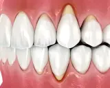 Zbliżenie na zęby i dziąsła, ukazujące odsłonięte korzenie zębów, co może być przyczyną tzw. gummy smile.