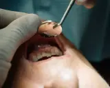 Dentysta używa lusterka, by sprawdzić, co wyciąga ropę z zęba.