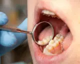 Koszt implantu siódemki: Cennik 2026 i ukryte wydatki!
