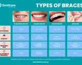 Porównanie aparatów ortodontycznych: tradycyjne, ceramiczne, Damon i Invisalign. Zęby wysunięte do przodu mogą być korygowane.
