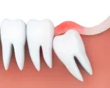 Zapalenie dziąseł wokół ósemki. Czy ósemki się leczy? Czasem wymagają interwencji dentysty.