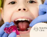 Uśmiechnięte dziecko z różową płytką Hawleya w ustach, przygotowywaną przez dentystę w rękawiczkach.