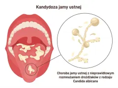 Ilustracja przedstawia jamę ustną z białymi nalotami, wskazując na kandydozę. Powiększony fragment ukazuje drożdżaki Candida albicans, przyczynę tej choroby jamy ustnej.