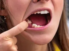Widoczne usta z otwartą jamą ustną, palec wskazujący na miejsce po wyrwanym zębie, gdzie widać skrzep. Brak widocznych szwów.