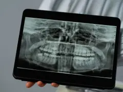 Rentgen szczęki na tablecie. Dentysta analizuje obraz, zastanawiając się, ile korzeni ma ząb 8.