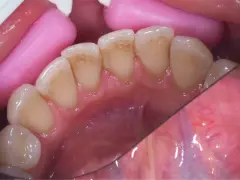 Widoczne przebarwienia na zębach, które można usunąć osad z zębów. Różowe separatory dentystyczne.