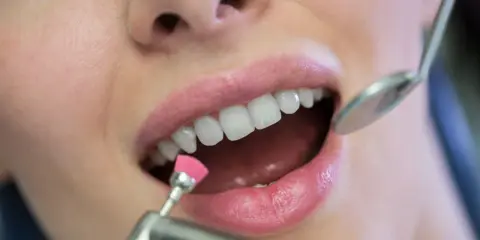 Profesjonalne usuwanie kamienia nazębnego. Dentysta poleruje zęby pacjentki małą, różową szczoteczką.