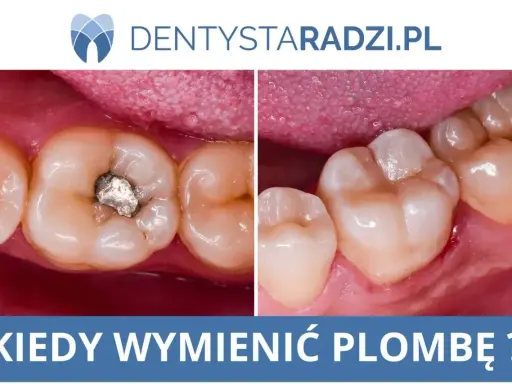 Porównanie zęba z amalgamatową plombą i zęba po wymianie na nową, estetyczną plombę. Kiedy wymienić plombę?