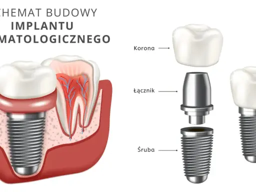 Schemat budowy implantu stomatologicznego. Dowiedz się, ile kosztuje wstawienie zęba i jak wygląda jego konstrukcja: śruba, łącznik i korona.