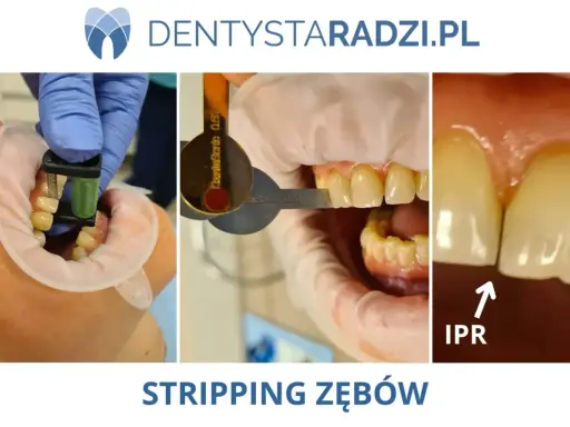 Stripping zębów: przed zabiegiem z użyciem narzędzi i po, widoczna poprawa przestrzeni międzyzębowych (IPR).