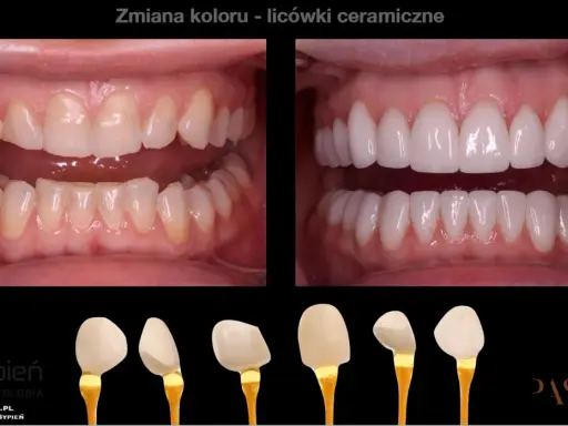 Przed i po metamorfozie zębów: od naturalnego koloru do olśniewającego, hollywoodzki uśmiech dzięki licówkom ceramicznym.