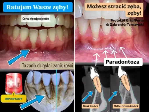 Zanikanie dziąseł i kości (paradontoza) może prowadzić do utraty zębów. Sprawdź, jaka jest recesja dziąseł cena leczenia.