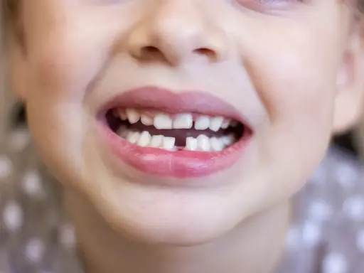 Uśmiechnięta buzia dwulatka z widocznym zgryzem otwartym. Brakuje dwóch przednich zębów mlecznych.