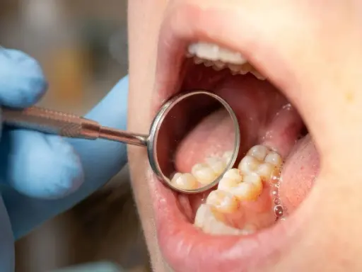 Koszt implantu siódemki: Cennik 2026 i ukryte wydatki!