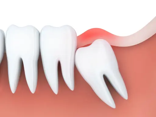 Zapalenie dziąseł wokół ósemki. Czy ósemki się leczy? Czasem wymagają interwencji dentysty.