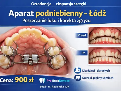 Aparat podniebienny, czyli aparat Hassa, poszerza łuk zębowy. Zdjęcia pokazują efekt przed i po leczeniu.