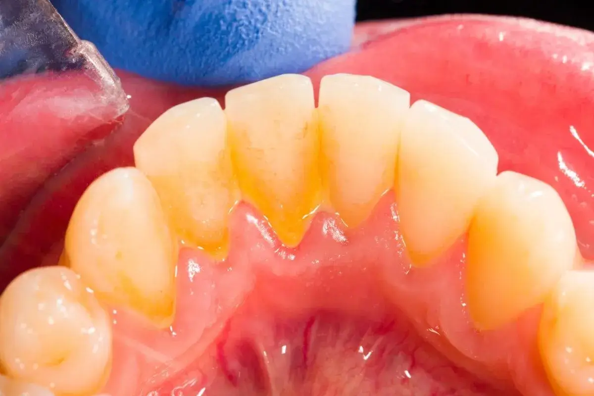 Widok zębów z widocznym, żółtawym kamieniem przy dziąsłach. Widać narzędzie dentystyczne i niebieską rękawiczkę.