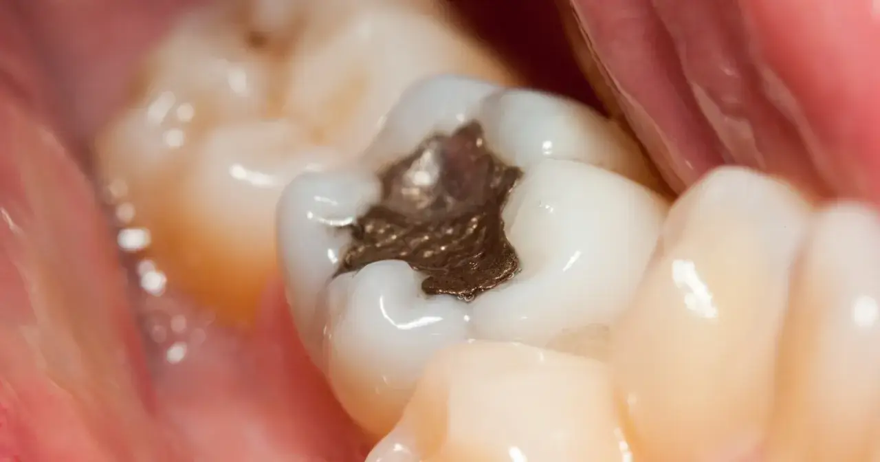 Zbliżenie na ząb z ciemną, metaliczną plombą. Widać też zdrowe, białe zęby i różowe dziąsło.