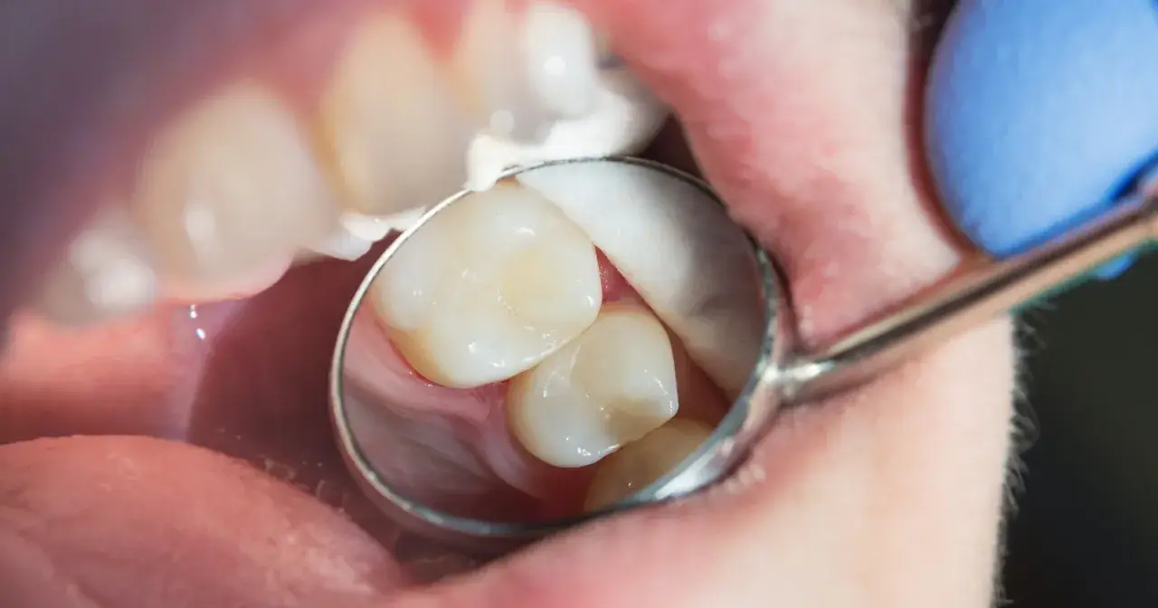 Widok jamy ustnej z lusterkiem dentystycznym, ujawniającym zęby. Uważne oko może dostrzec oznaki **próchnicy ukrytej** między zębami, wymagającej interwencji.