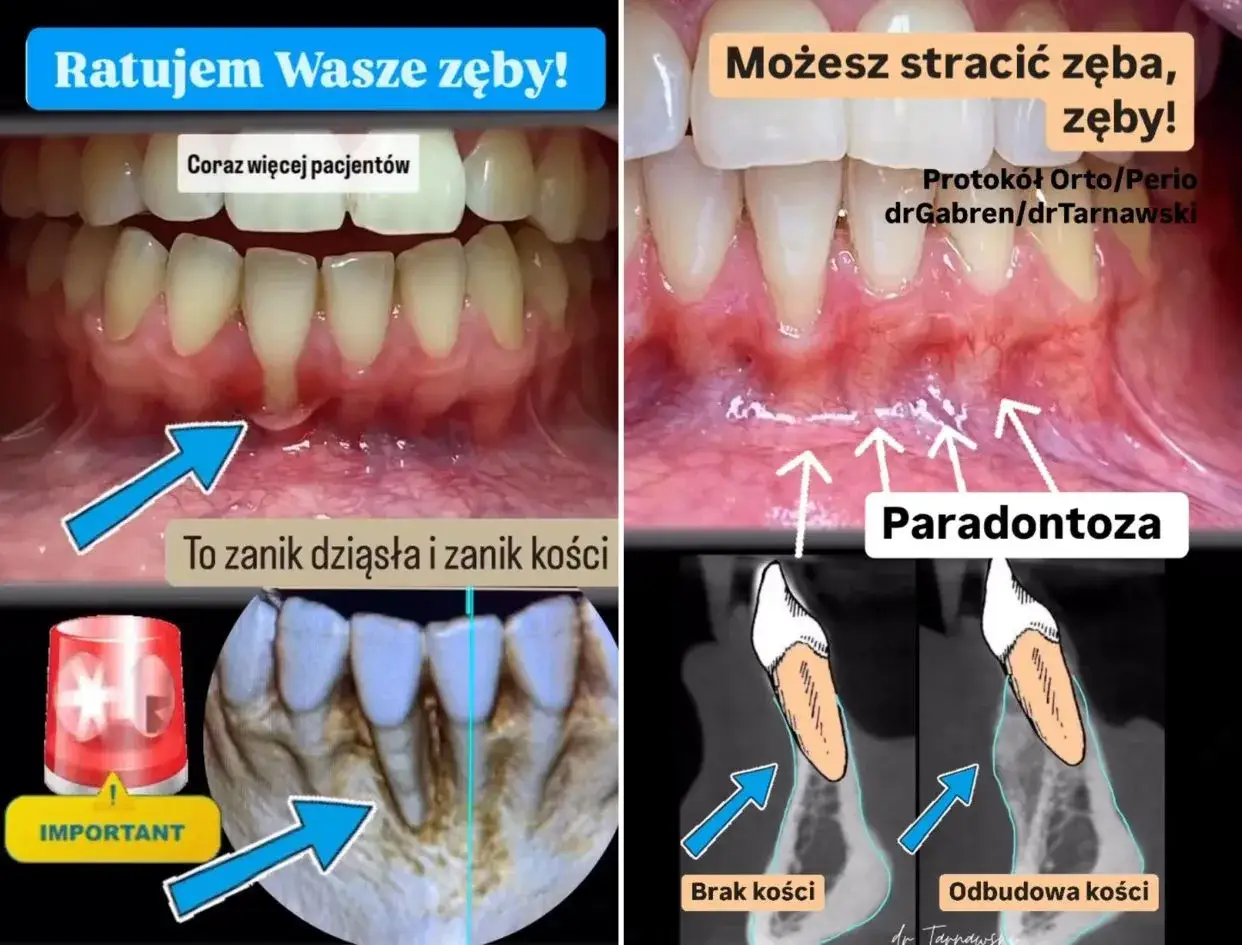 Gingiwoplastyka ratuje zęby przed paradontozą i zanikiem kości. Zdjęcia pokazują postęp leczenia.