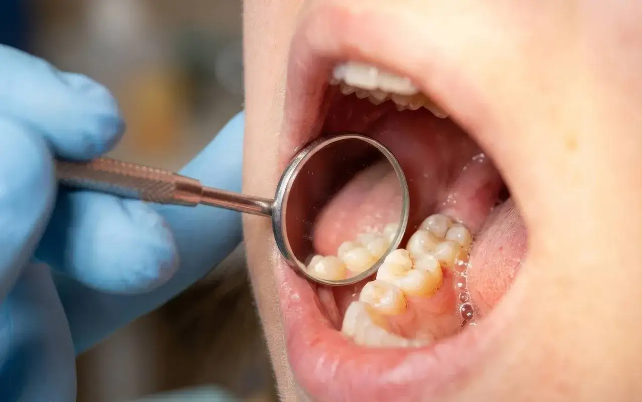 Dentysta bada zęby, szukając próchnicy między zębami.