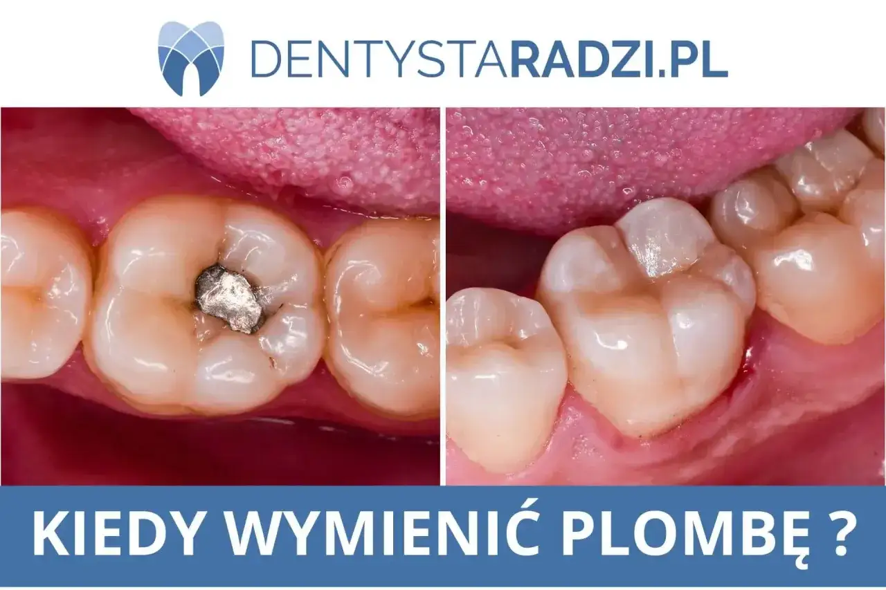 Porównanie zęba z nieszczelną plombą i zęba po jej wymianie. Zdjęcie pokazuje, jak ważna jest wymiana starej plomby.